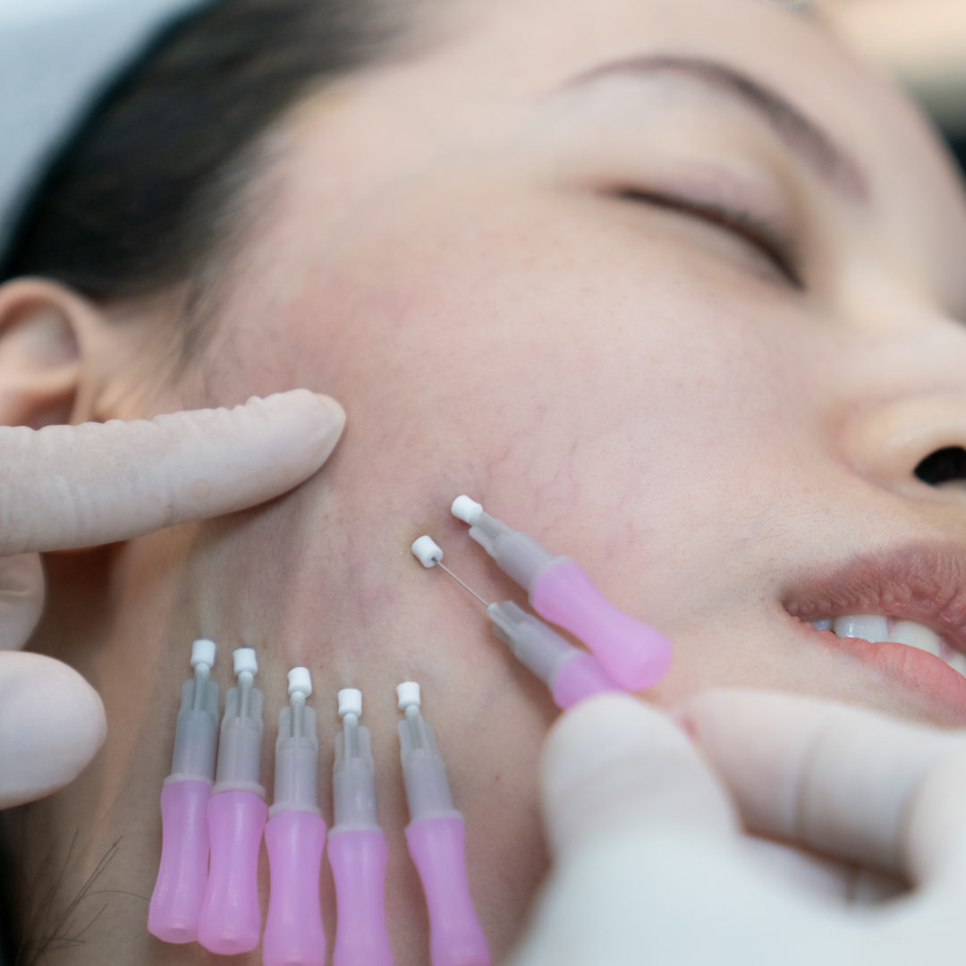 ショートスレッド