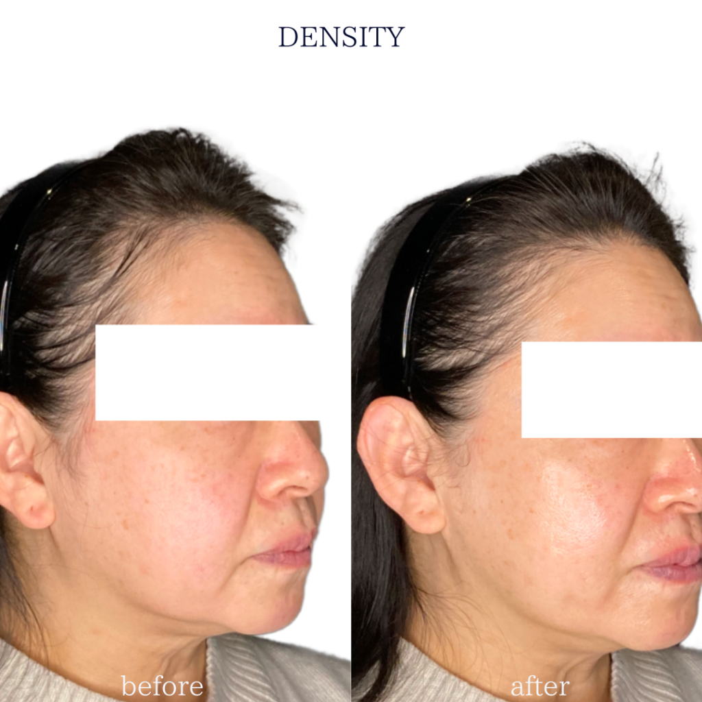 DESNSITY(デンシティ)の施術症例