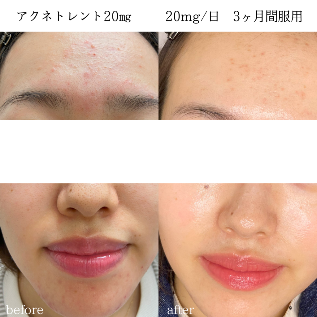 アクネトレント（イソトレチノイン）２０ｍｇを３ヶ月間服用された女性の患者様の症例