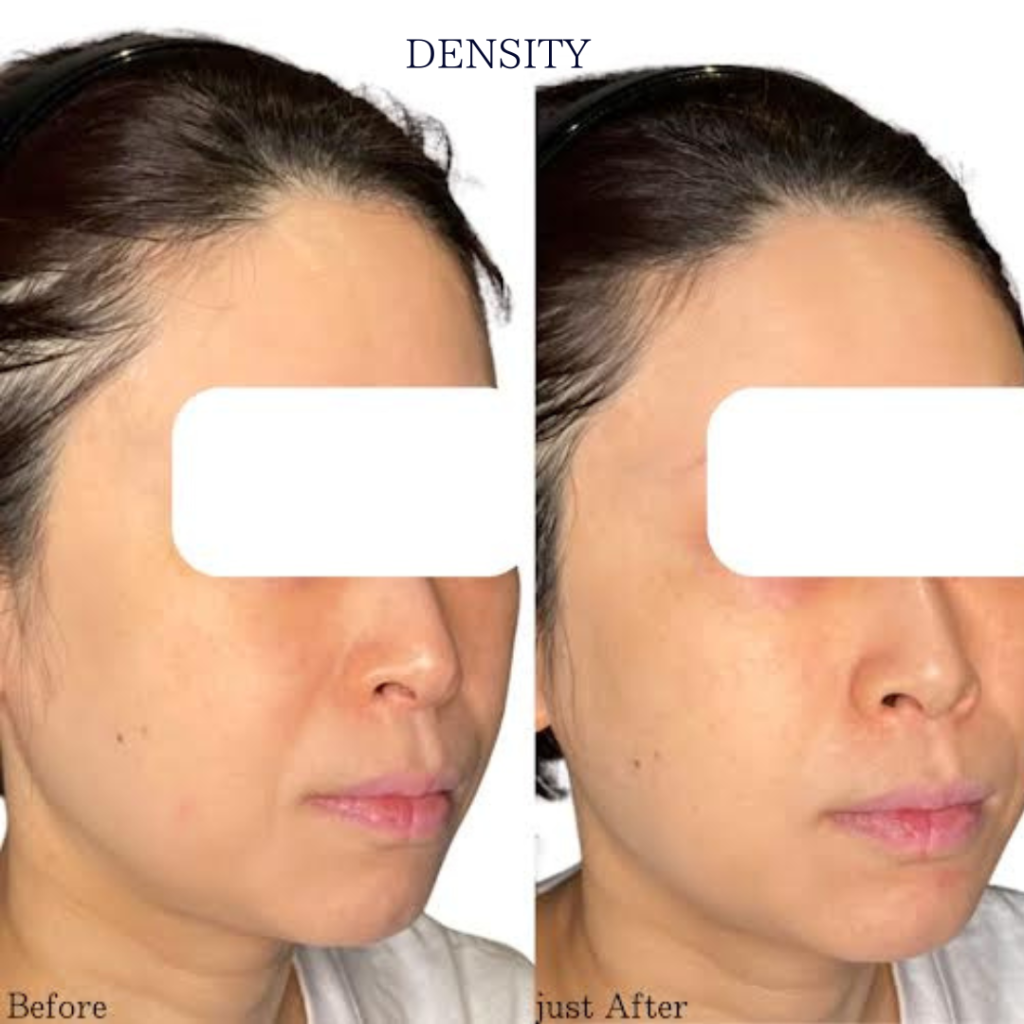 DESNSITY(デンシティ)の施術症例