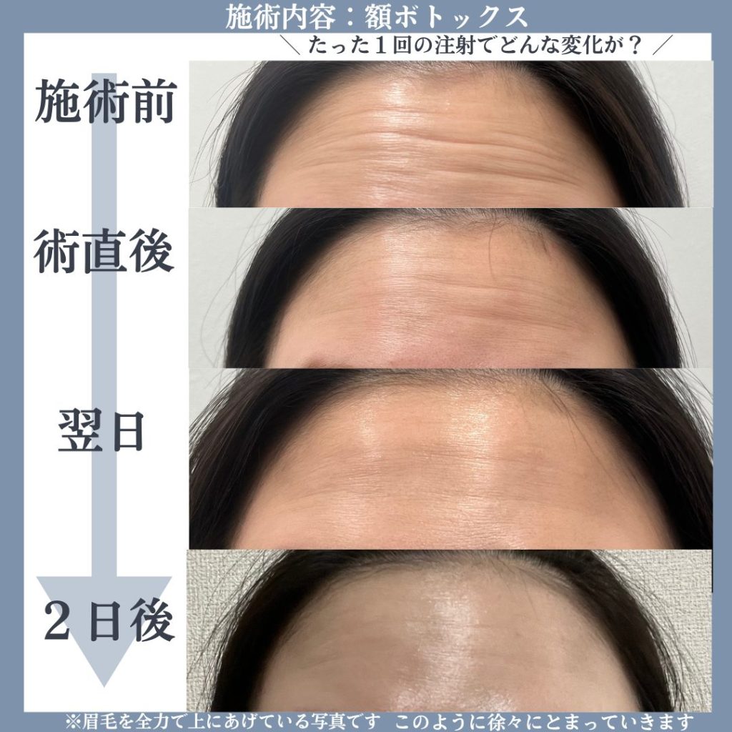 額のボトックスの施術の変化