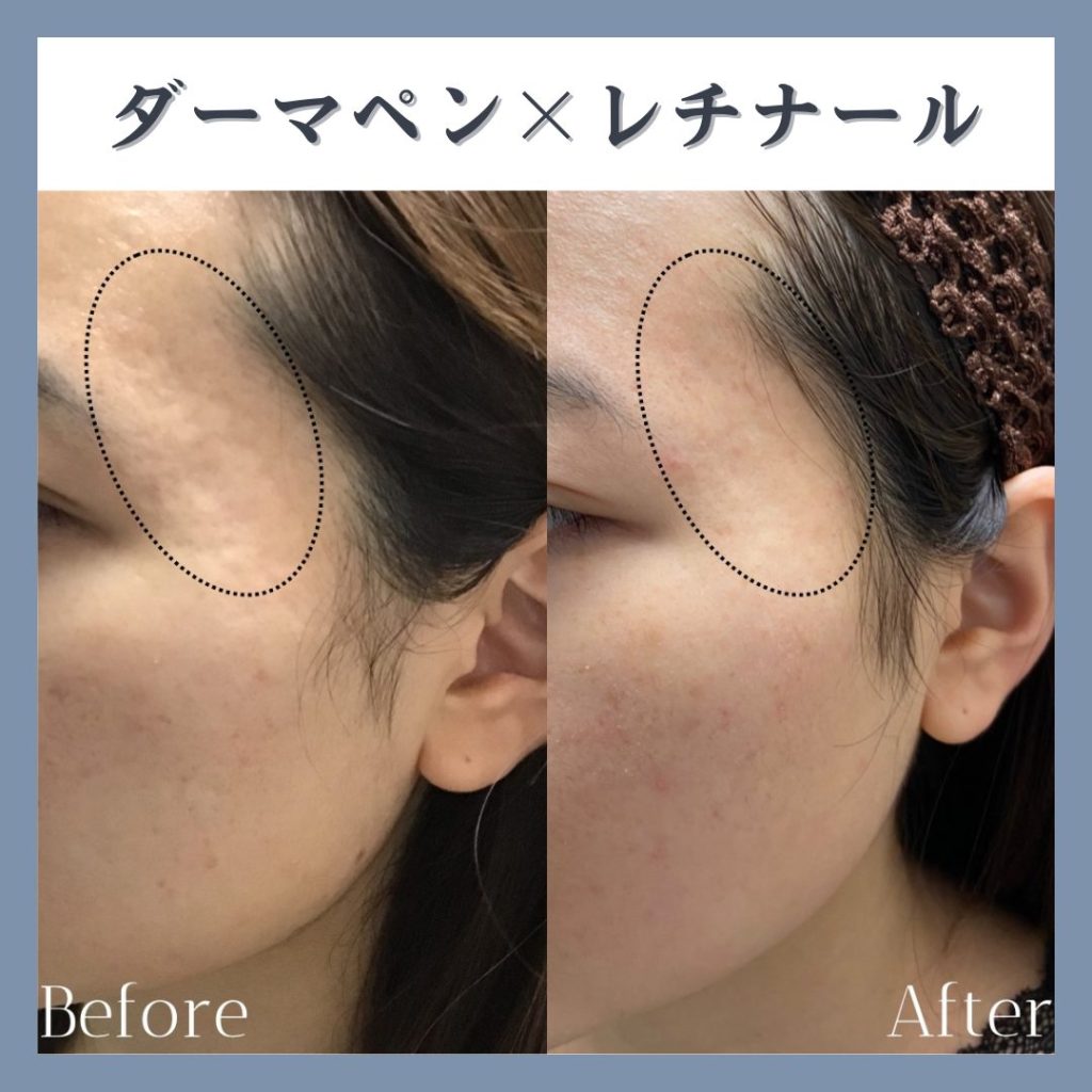 ニキビ跡に対して実施したダーマペン、レチナールの施術症例