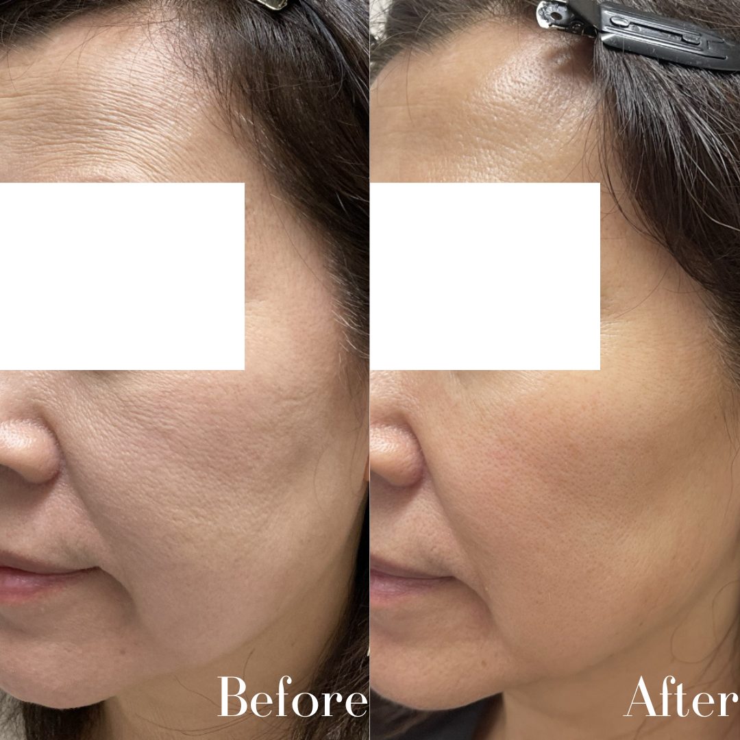 ケミカルピーリングの症例写真