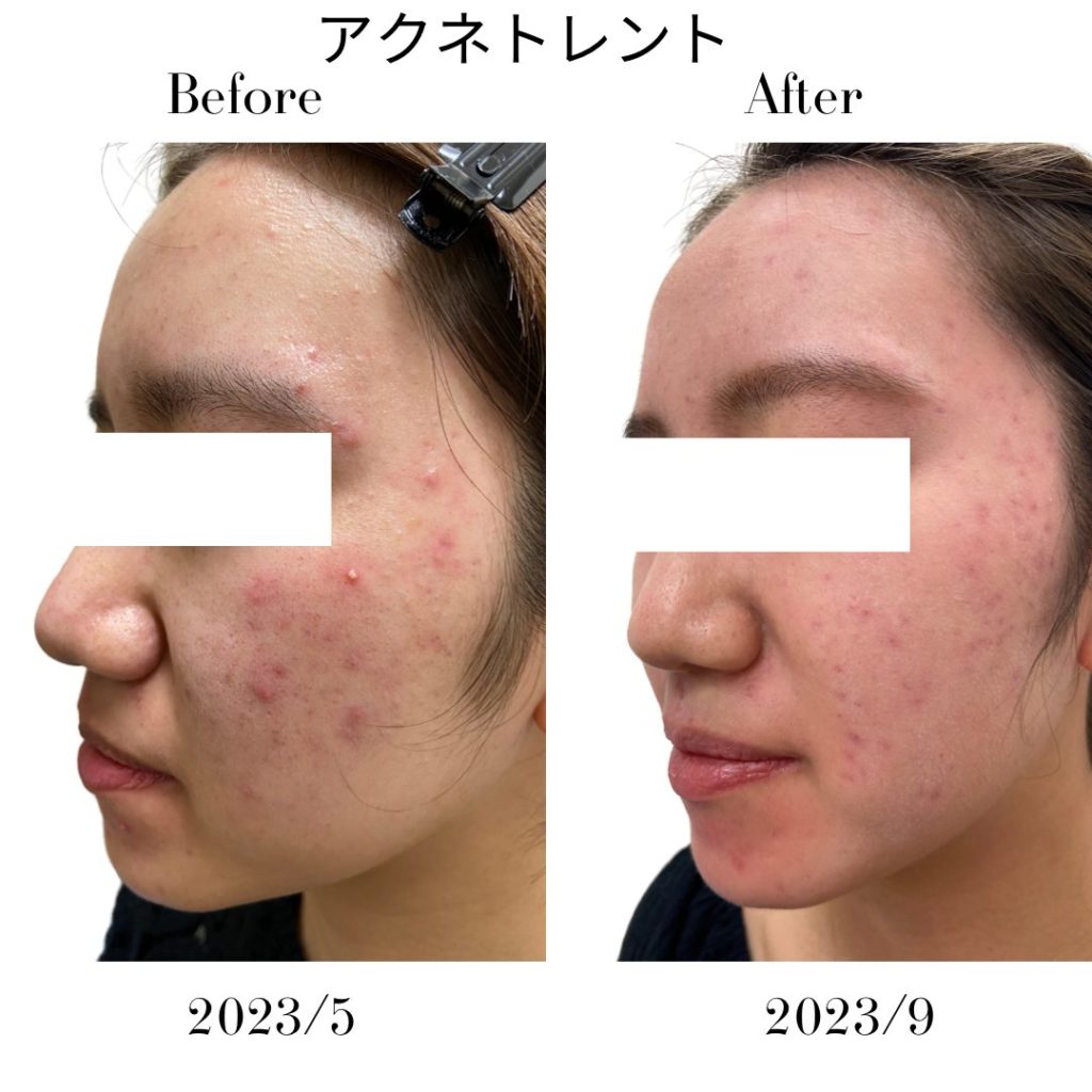 ニキビに対して5ヶ月アクネトレント（イソトレチノイン）を服用された女性の患者様