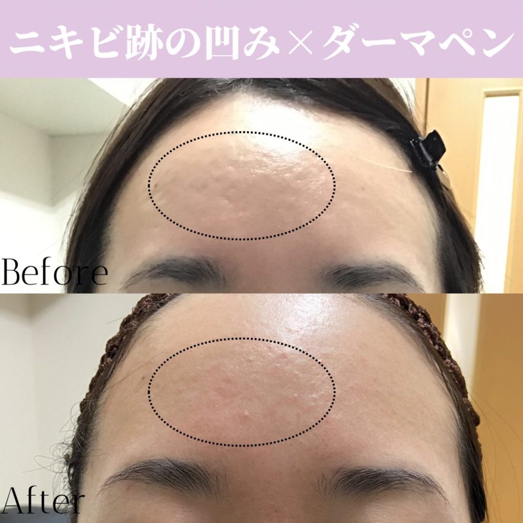 ニキビ跡の凹みに対してダーマペン施術の症例写真
