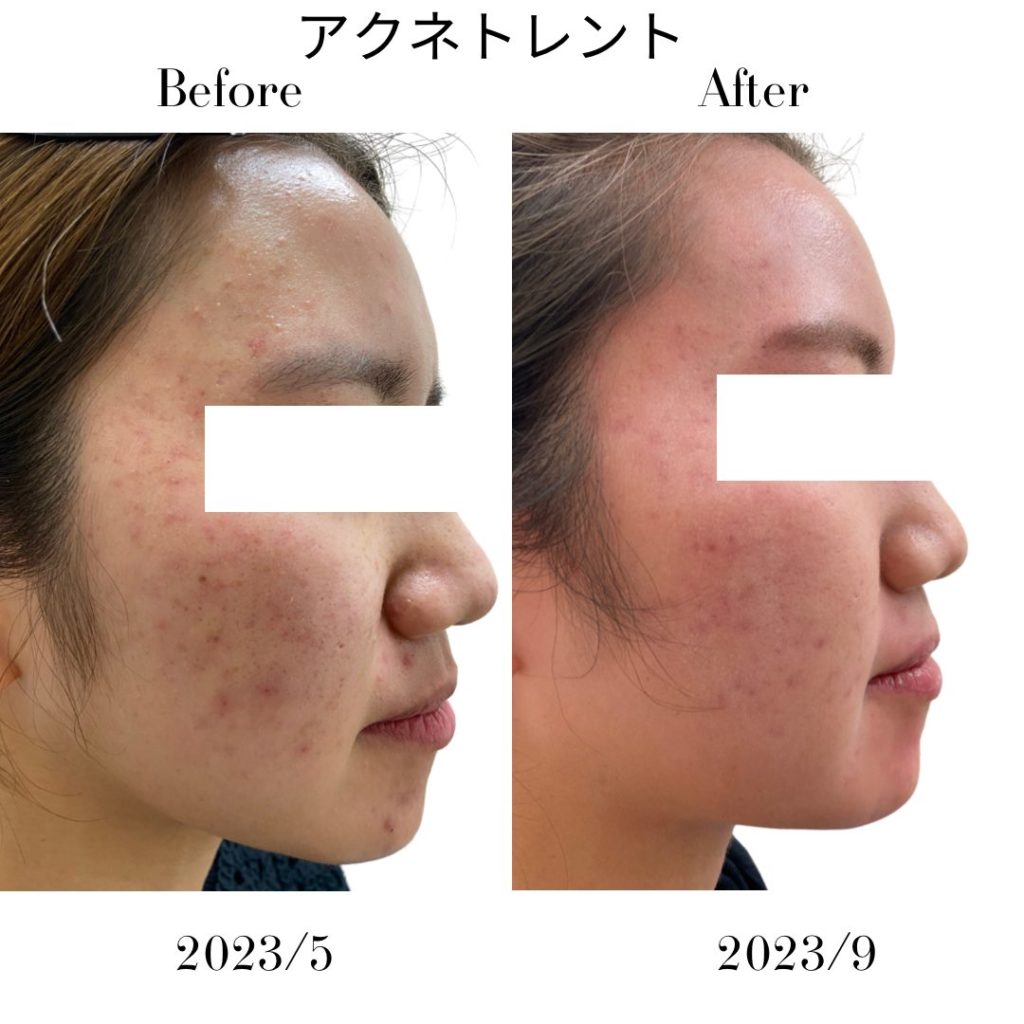 ニキビに対して5ヶ月間アクネトレント（イソトレチノイン）を服用された患者様のBefor,After