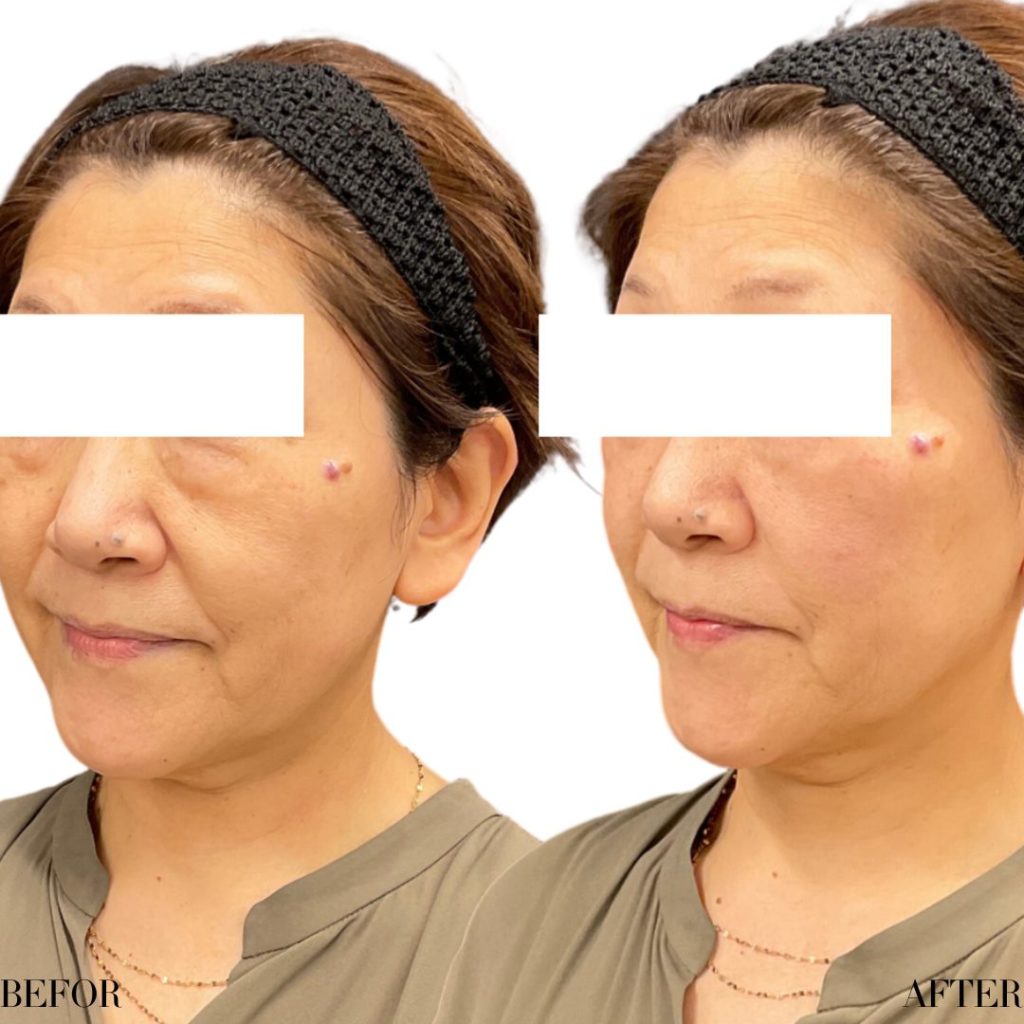 ヒアルロン酸注射にて、たるみ治療をされた女性の患者様の症例