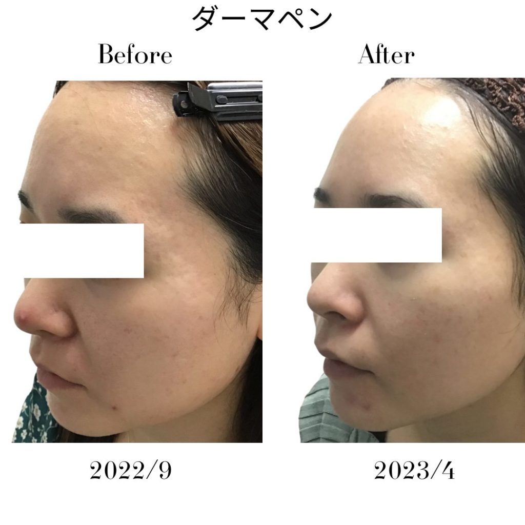 ダーマペンの症例写真