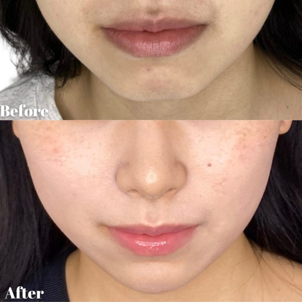 ヒアルロン酸注射にて、たるみ治療をされた女性の患者様の症例