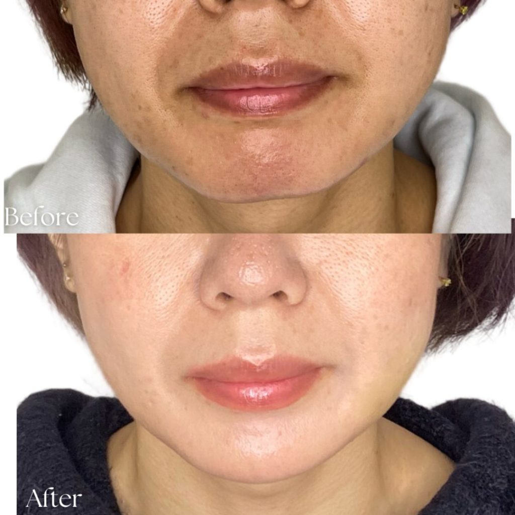 ヒアルロン酸注射にて、たるみ治療をされた女性の患者様の症例