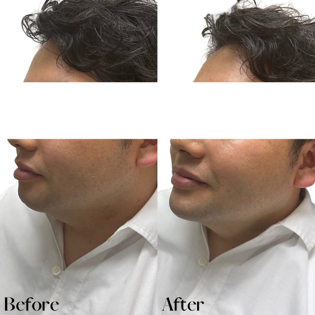 ヒアルロン酸注射にて、たるみ治療をされた男性の患者様の症例