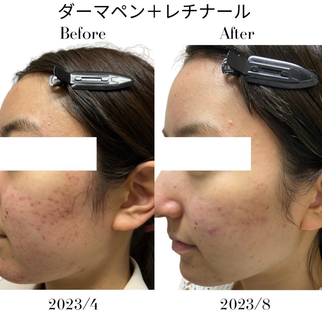 ニキビ跡に対して実施したダーマペン、レチナールの症例写真