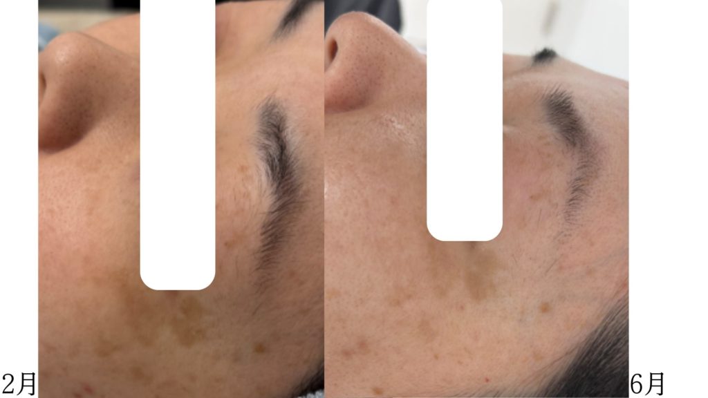 肝斑注射の症例写真