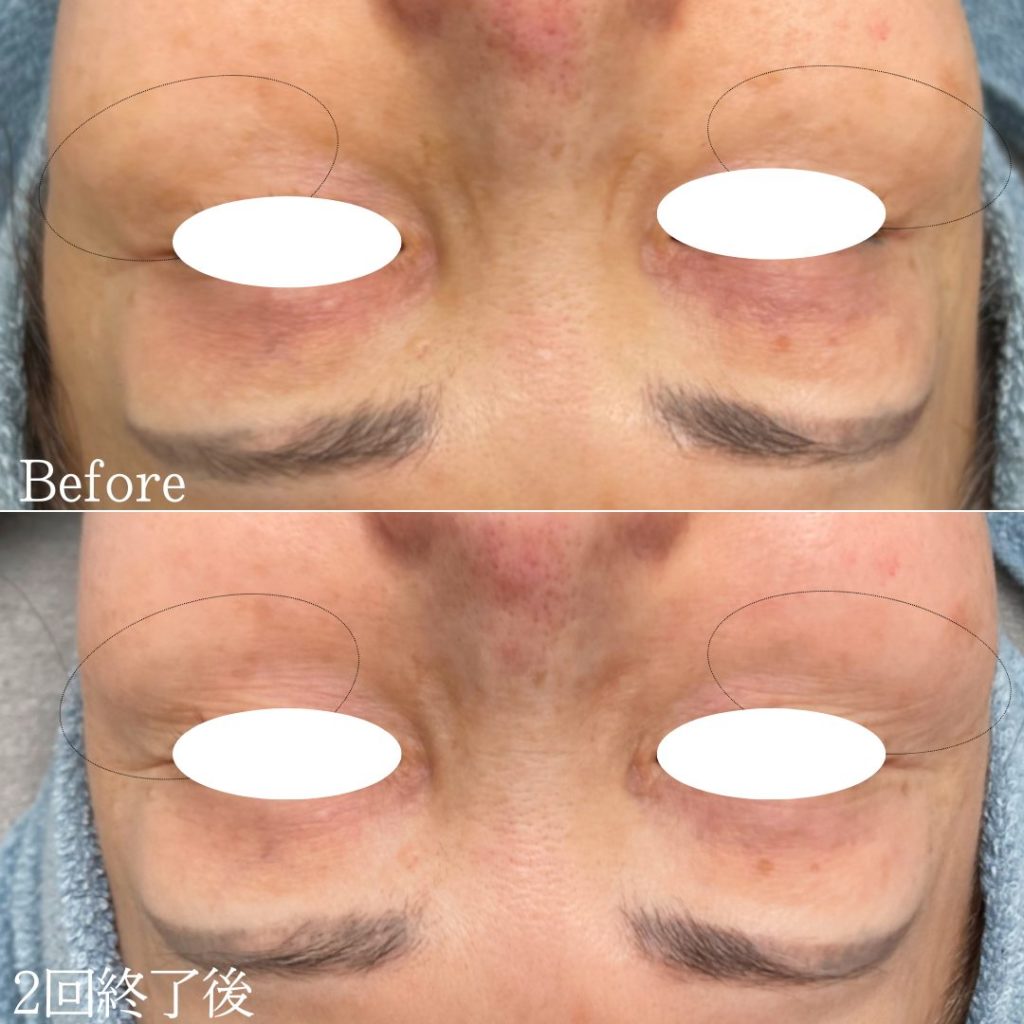 肝斑注射の症例写真