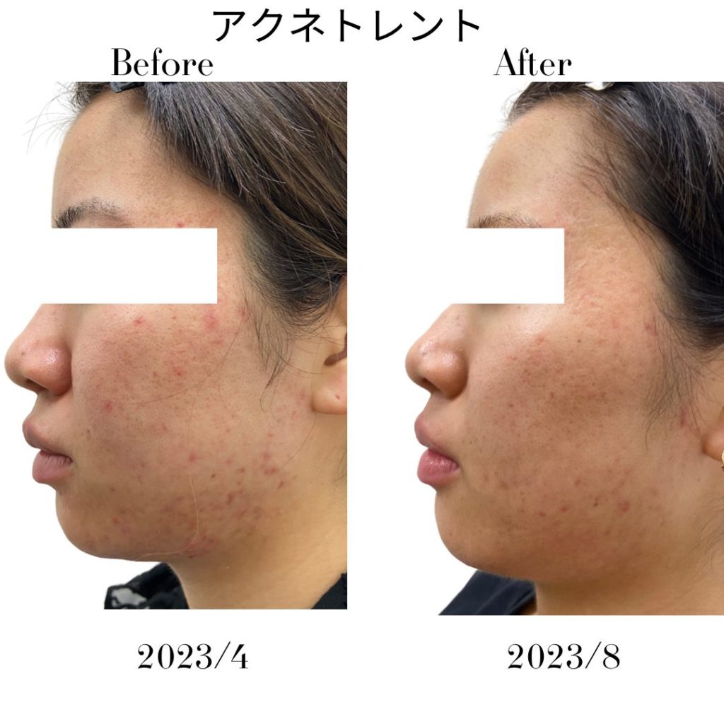ニキビに対してアクネトレント（イソトレチノイン）を5ヶ月間服用した症例