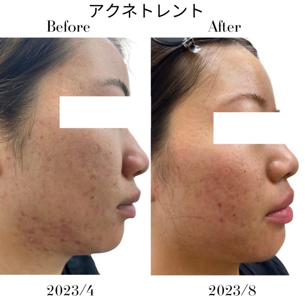 ニキビに対してアクネトレント（イソトレチノイン）を5ヶ月間服用した症例