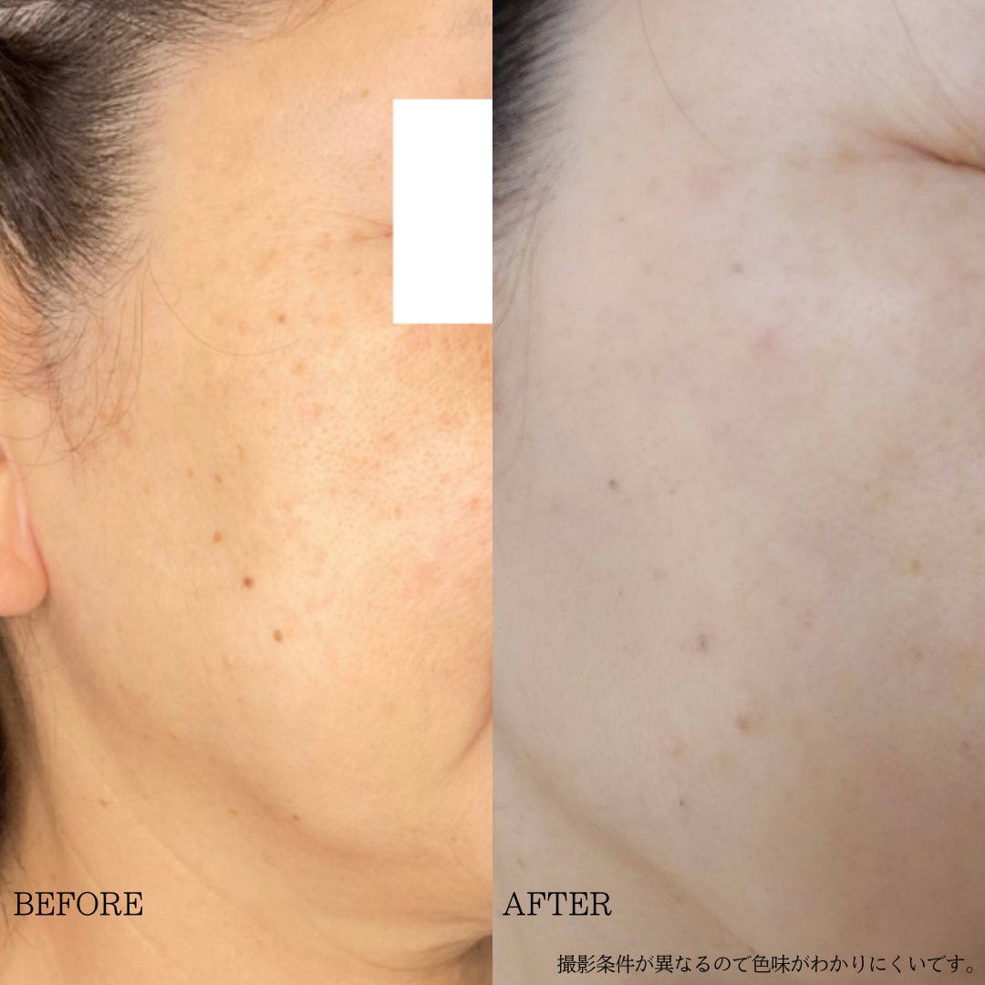 Cellec V 症例写真 50代女性 シミ・くすみ改善