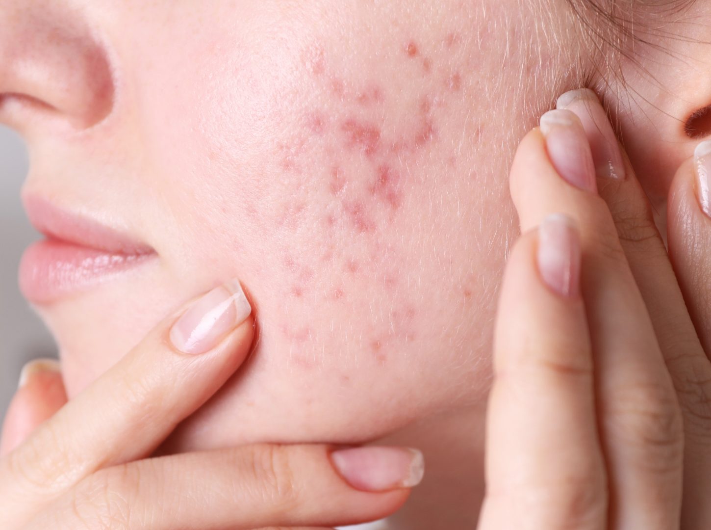 複合的なニキビ跡のイラスト