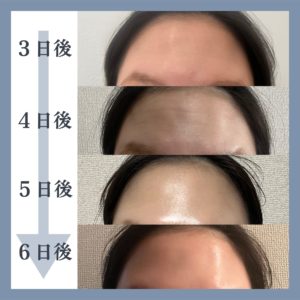 ボトックスの経過の写真3日後〜６日後